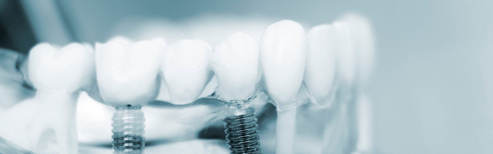 + Q Dientes implantes dentales